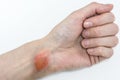 Blister made by boiling water  on young womanÃ¢â¬Ës hand on isolated white, burn of a skin on femaleÃ¢â¬â¢s wrist Royalty Free Stock Photo